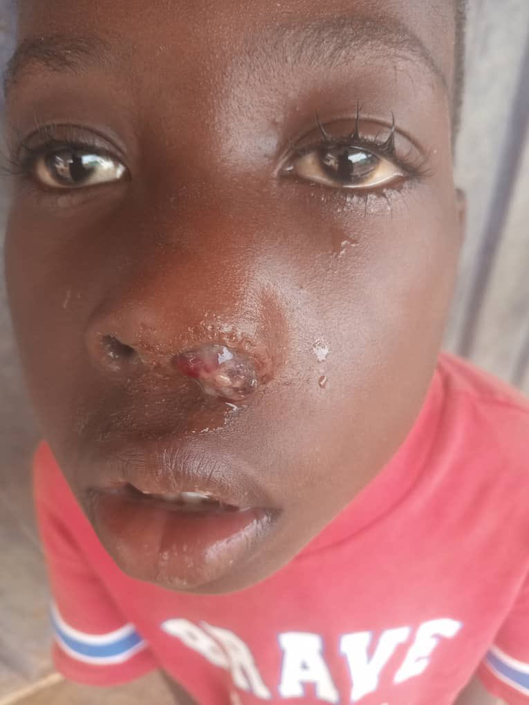 bonesmantv's tweet photo. Guys this 6years Old Kofi Opoku Justin needs only GHc8,000 to be able to breath through his nose. He currently breath through his Mouth which is quite challenging. 
I need 160 people to each Support Justin with at least 50cedis to save this little boy. 

𝗗𝗶𝗮𝗹 *713*034# OR

𝐃𝐨𝐧𝐚𝐭𝐞 𝐯𝐢𝐚 𝐌𝐨𝐛𝐢𝐥𝐞 𝐌𝐨𝐧𝐞𝐲 𝐭𝐨:
054 016 9707
020 207 2024
(𝗖𝗹𝗶𝗻𝘁𝗼𝗻 𝗬𝗲𝗯𝗼𝗮𝗵)

𝐆𝐨𝐅𝐮𝐧𝐝𝐌𝐞: link in comment.

https://t.co/haYZRWpUG9
𝗣𝗹𝗲𝗮𝘀𝗲 𝗚𝗶𝘃𝗲 𝘂𝘀 𝗮 𝗙𝗼𝗹𝗹𝗼𝘄 𝗔𝗻𝗱 𝗸𝗶𝗻𝗱𝗹𝘆 𝗦𝗵𝗮𝗿𝗲 𝘁𝗼 𝗛𝗲𝗹𝗽 𝗦𝗮𝘃𝗲 𝗮 𝗟𝗶𝗳𝗲