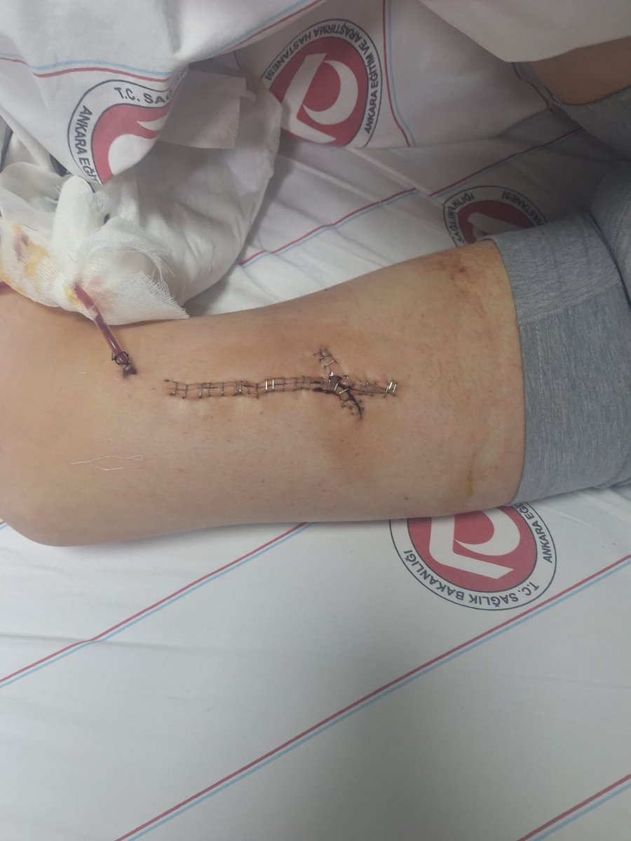 EzgiYiilmaz's tweet photo. Umut, Osman Yüksel Serdengeçti İmam Hatip Ortaokulu'nda yaşadığı bıçaklandı. Bıçak damarına denk geldiği için kanlar içinde kaldı!!
Okul ve ders saatleri içerisinde, sınıf içinde gerçekleşen bu korkunç olayda Umut  sol bacağından ağır yaralandı.

Bıçaklayankaçtı,fakat yakalanıp getirildi. Olay yetkili mercilere bildirildi. Aile şikayetçi.

Peki bıçaklayan çocuğa ne oldu derseniz?
Okula gitmeye derslere girmeye devam ediyor.

Babanın İDDİASI, bazı çocuklar okula bıçak getirip , diğer çocuklara satıyor. 
Sessiz kalmaya devam mı?
Üstelik yine ailenin  iddiası diğer aile tanıdıklar vasıtasıyla olayı kapatmaya çalışıyor.
@adalet_bakanlik
@tcmeb 

#UmutSırakayaİçinAdalet
