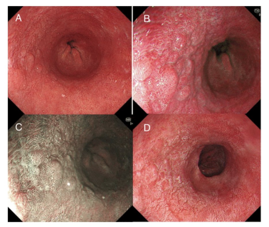 FrontGastro_BMJ's tweet image. 🔥 New comprehensive EXCELLENT guidance on best practices for Upper GI endoscopy from the BSG and Upper GI Surgeons of Great Britain and Ireland❗ 🔗 bit.ly/3Rb5FGB

🔵 Learn how to adequately prepare prior to an Upper GI endoscopy
🔵 Learn how to preform a complete exam