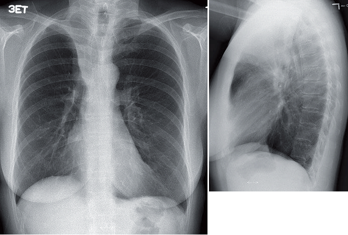 ManualOMedicine's tweet image. 62-year-old woman with a 2-month history of a nonproductive cough receives this chest radiograph.
- What’s the diagnosis ?

#medtwitter #foamed #meded #foamrad