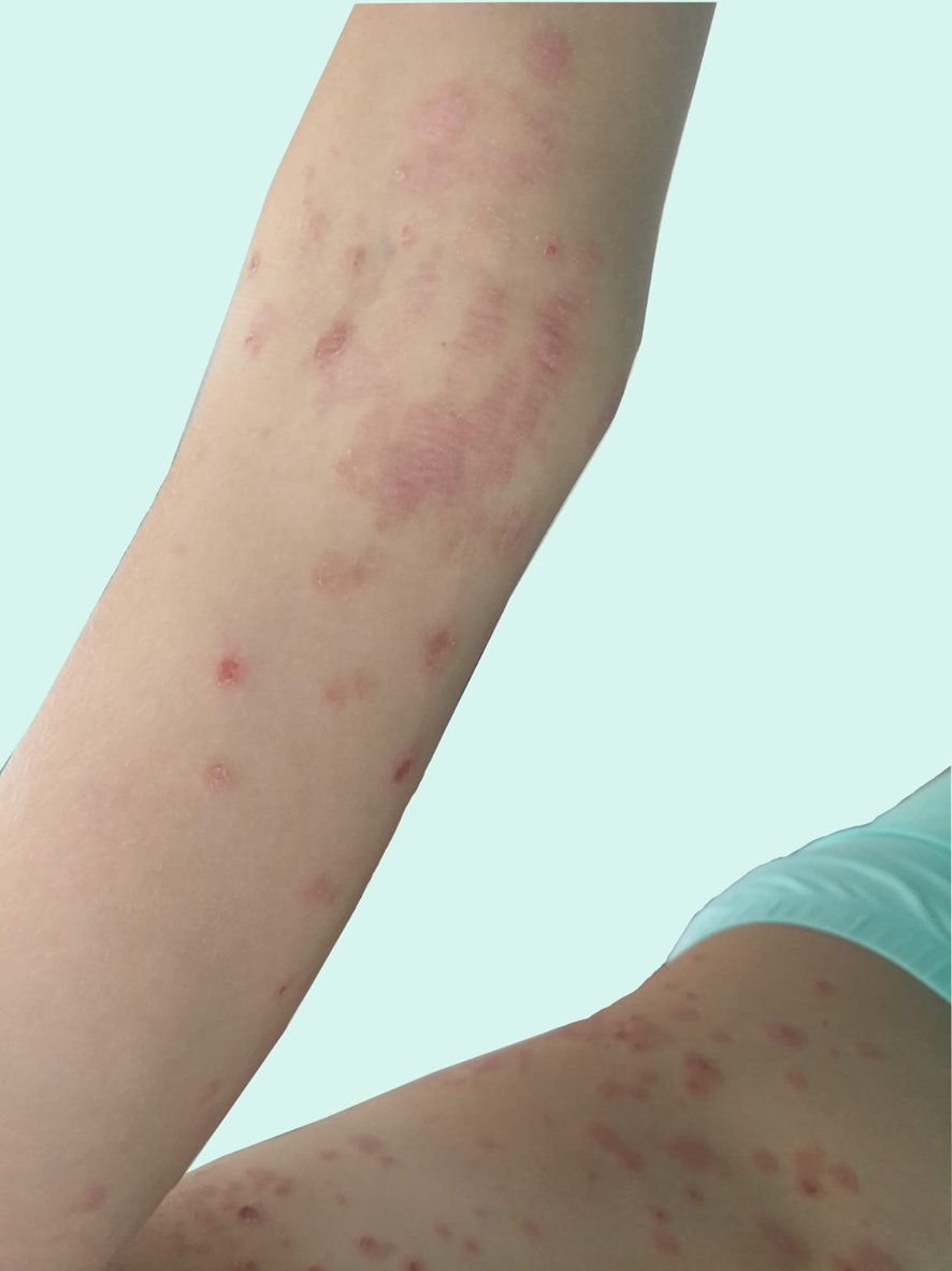 guerreroespejo's tweet image. 11 años♀️, dermatitis atópica, tras picaduras de mosquitos, durante un viaje a Bosnia: lesiones eritematosas pruriginosas, que se han extendido, con aparición de costras y placas con vesículas.
1/2

🖋️ López E, Barchino LM. continuum.aeped.es
#pediatria #MedEd