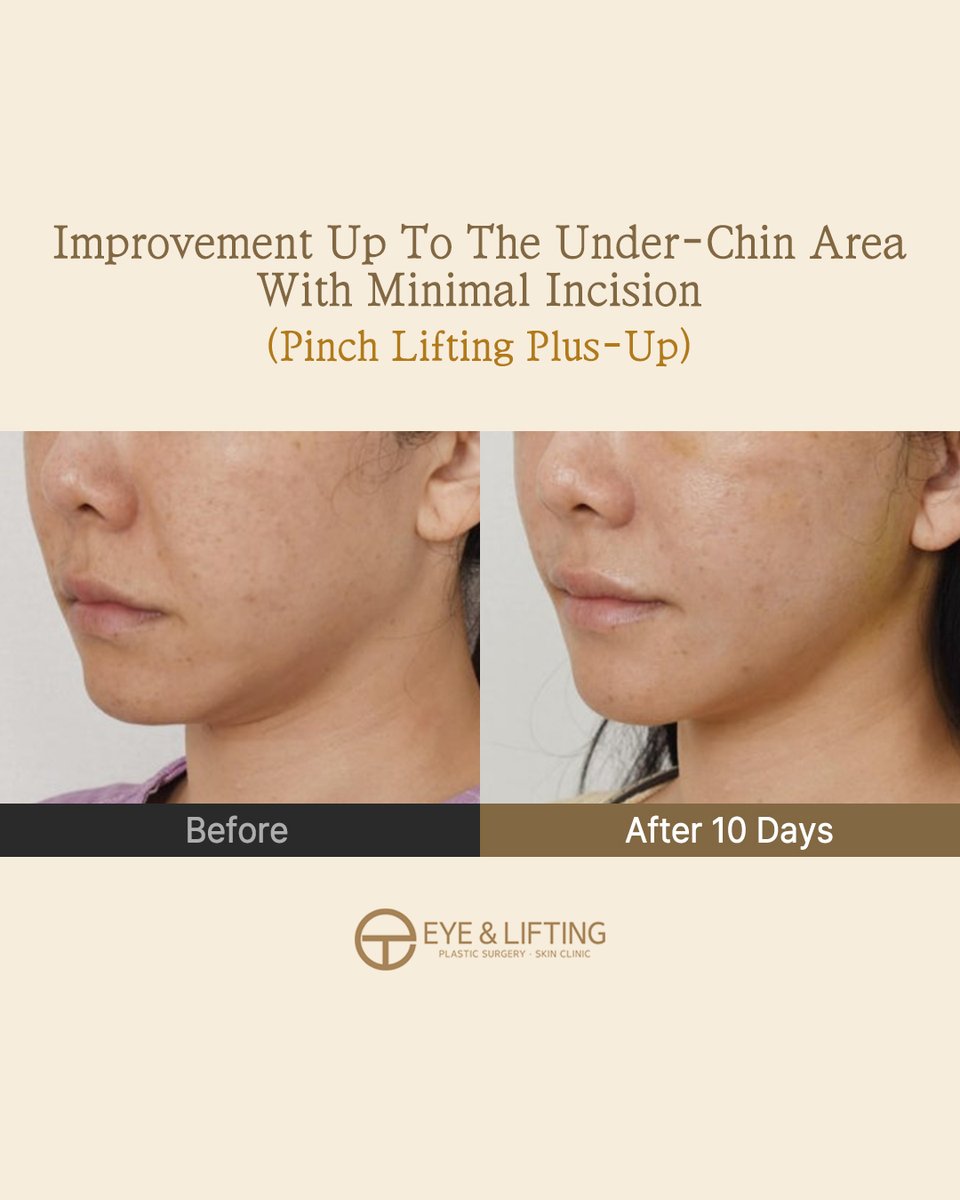 EyeLiftingPS's tweet photo. Interested in mid-to-lower face lift?

Our Pinch Lifting Plus Up (SMAS mini facelift) is the solution.

Why? The effects are improved:

✅Cheek sagging
✅Nasolabial folds
✅Under-chin sagging
✅Marionette lines
✅Perioral wrinkles
✅Jawline

Now is the time to consult 🕊️💎👇🏻 https://t.co/Q0Fgn8vsz2