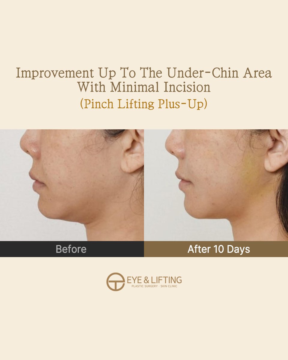 EyeLiftingPS's tweet photo. Interested in mid-to-lower face lift?

Our Pinch Lifting Plus Up (SMAS mini facelift) is the solution.

Why? The effects are improved:

✅Cheek sagging
✅Nasolabial folds
✅Under-chin sagging
✅Marionette lines
✅Perioral wrinkles
✅Jawline

Now is the time to consult 🕊️💎👇🏻 https://t.co/Q0Fgn8vsz2