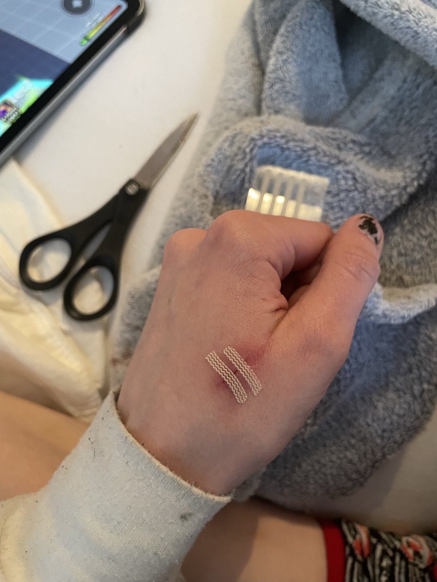 Ncity1270000's tweet image. Fucking bullshit I had to do so this stupid MINI styro can actually heal bc it tripled in size bc I kept picking at it. And it got those red lines a few times💔
#shtwt #fml