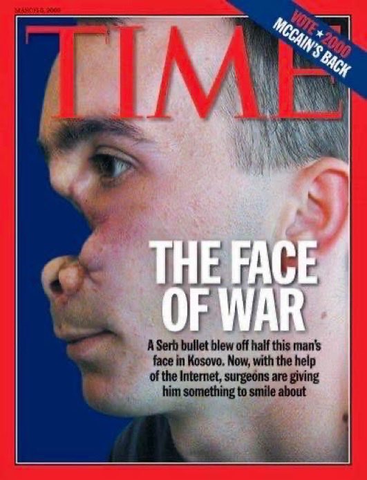fbujupi_kosova's tweet photo. April 29, 1999 , a rainy day in Kosovo, should really have been the last of Besim Kadriu’s life. That morning, in the Albanian sector of the town of Mitrovica, Serb paramilitaries torched the house the 21-year-old economics student shared with his pregnant wife Valbona. Watching the inferno from a distance, Kadriu was confident Valbona had escaped but was unsure where she had fled. He set off on foot for the village of Zaza, a few miles away, on a hunch she would be there with her two brothers. She wasn’t, but a large number of Serb militiamen were. Thugs in balaclavas surrounded the village in three rings, moving inward to trap the inhabitants. Knowing they were targets, Kadriu and a few other men tried to escape. They managed to pass the two inner cordons undetected.
But as the men attempted to cross the third, they were spotted. One of Kadriu’s brothers-in-law was shot dead on the spot. Kadriu and the other brother-in-law ran for the woods. The brother-in-law was shot in the leg, but kept running and survived. Kadriu felt a bullet sting his face, fell to the ground and played dead. Much of one side of his previously handsome face, including his entire nose and an eye, had been removed by the shot. 

A strong-minded, pragmatic man, Kadriu resolved to avoid glimpsing any reflection of himself in puddles left by the rain, even though he needed them to drink from. For his psychological survival, this was probably a good tactic. So grotesque were his injuries that when he finally judged it safe to return to Zaza, he went unrecognized. People scurried from him in horror until he produced a photo he happened to have in the back pocket of his jeans. It showed him and Valbona smiling for the camera a few months before, at Christmas 1998, days after they had married.
Besim Kadriu still keeps that photo in his wallet as a lucky charm, for while some people would opt for death rather than disfigurement, he considers himself a fortunate man. For one thing, a couple of centimeters farther back and that Serb bullet would have hit his brain. For another, he was reunited with Valbona and survived for three months in the care of relatives. He was still avoiding mirrors when the Kosovo Force peacekeepers arrived. But luckiest of all–and thanks to the efforts of an American doctor and a British military medic with a bag full of electronic gizmos and an Internet connection–Kadriu’s face has been rebuilt by surgeons in Manchester, England.

JONATHAN MARGOLIS / TIME