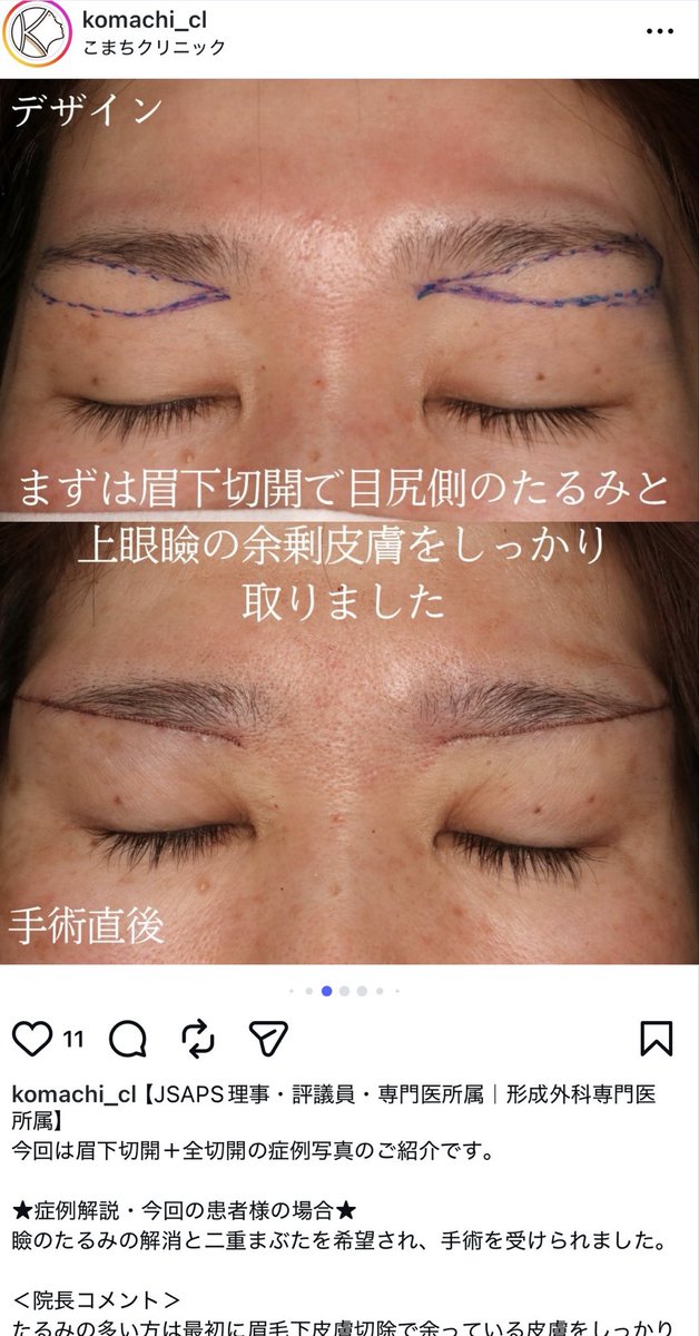 sss02656589's tweet photo. こまちの眉下切開の縫い目ヤバない？ここまで細かいの初めてみた。 https://t.co/UntRmOOre8