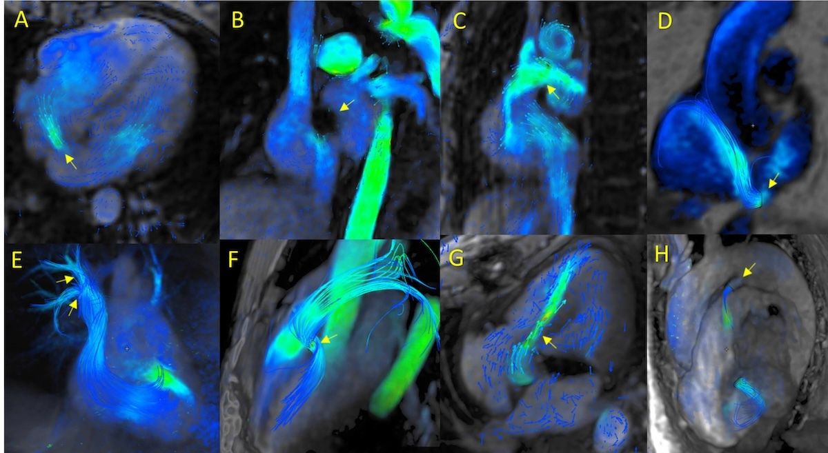 ImagenCardiaca's tweet photo. 4D-Flow CRM: revisión de la experiencia de 8 años
👓 https://t.co/Sm4IEgJrkz ◀️
Si tuviéramos que convertirlo en una regla de laboratorio: 4D-Flow no es para “ver flujo”, es para responder preguntas que no se dejan responder con un plano
✅ En "García Fernández te pone al día" https://t.co/LhCLR1IIuE
