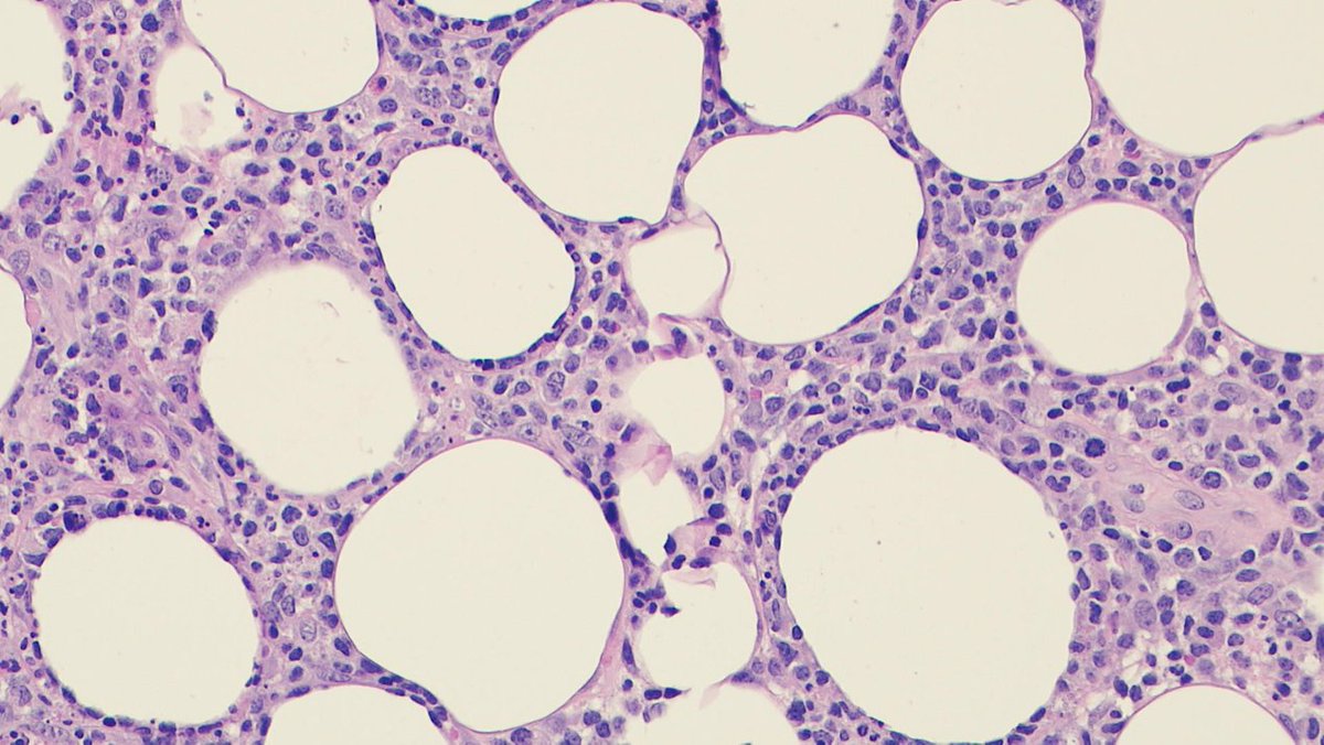 javidiparsijani's tweet photo. A case of Primary cutaneous gamma-delta Tcell lymphoma (#PCGDTCL) that mimics subcutaneous #panniculitis like T cell lymphoma.
One key difference is in the name itself: PCGD-TCL is gamma-delta positive (IHC) disease. It is an aggressive disease with HLH.
#skinlymphoma
#hemepath https://t.co/g1px5PWDT0