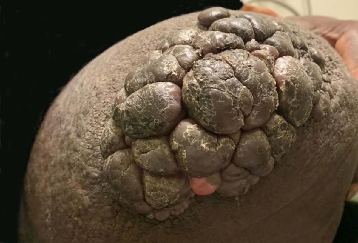 JMGardnerMD's tweet image. Amputation stump. Diagnosis?
Answer ✅ youtu.be/oYqKbtPrF38?si…
More pics: kikoxp.com/posts/11612
Other examples: kikoxp.com/posts/11613 &amp;amp; (warning: GRAPHIC!)kikoxp.com/posts/11614 
#pathology #pathologists #pathTwitter #dermpath #dermatology #dermatologia #dermtwitter