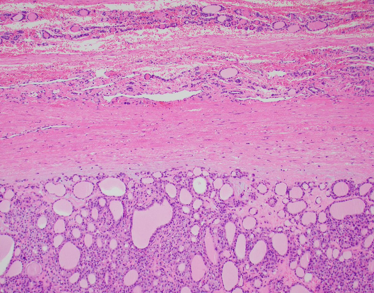 DrCycloPath's tweet image. #PathQuiz 🔬🦋 #ThyroidPath

A) NIFTP
B) IEFVPTC
C) Cribriform Morular Thyroid Carcinoma
D) Classic Papillary Thyroid Carcinoma

#Pathology #ThyroidPath