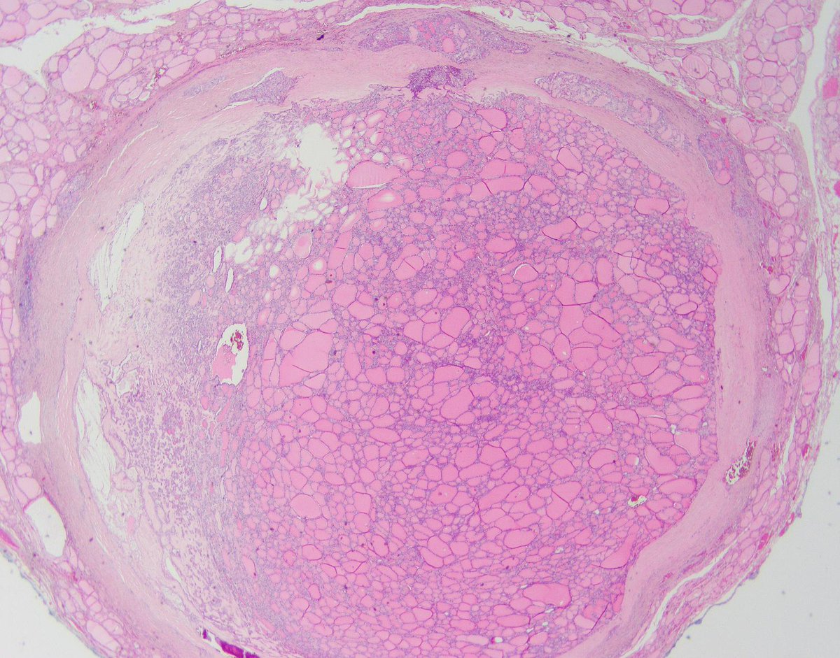 DrCycloPath's tweet image. #PathQuiz 🔬🦋 #ThyroidPath

A) NIFTP
B) High-grade follicular cell-derived thyroid carcinoma
C) Oncocytic Carcinoma
D) Invasive Encapsulated Follicular Variant of Papillary Thyroid Carcinoma

#Pathology #ThyroidPath