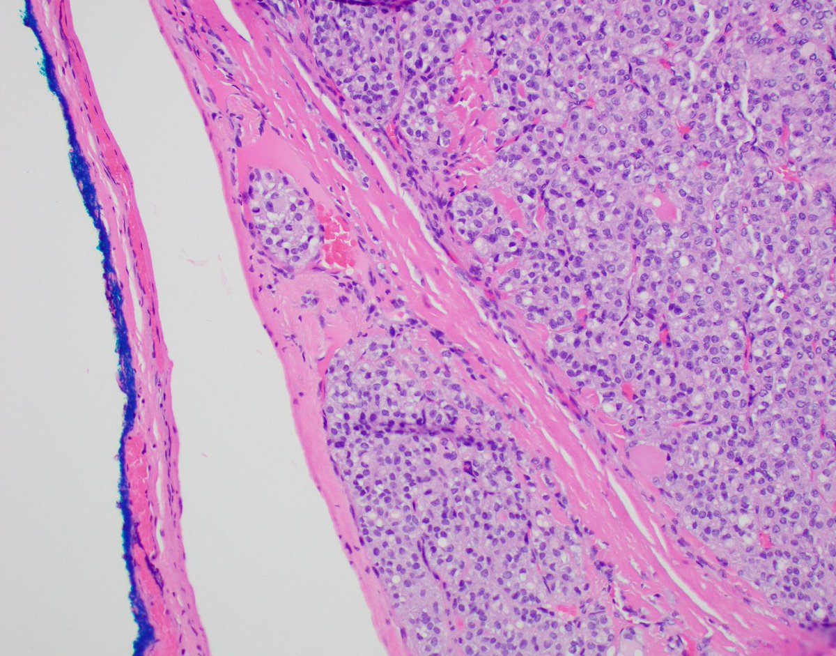 DrCycloPath's tweet image. #PathQuiz 🔬🦋 #ThyroidPath

A) NIFTP
B) High-grade follicular cell-derived thyroid carcinoma
C) Oncocytic Carcinoma
D) Invasive Encapsulated Follicular Variant of Papillary Thyroid Carcinoma

#Pathology #ThyroidPath