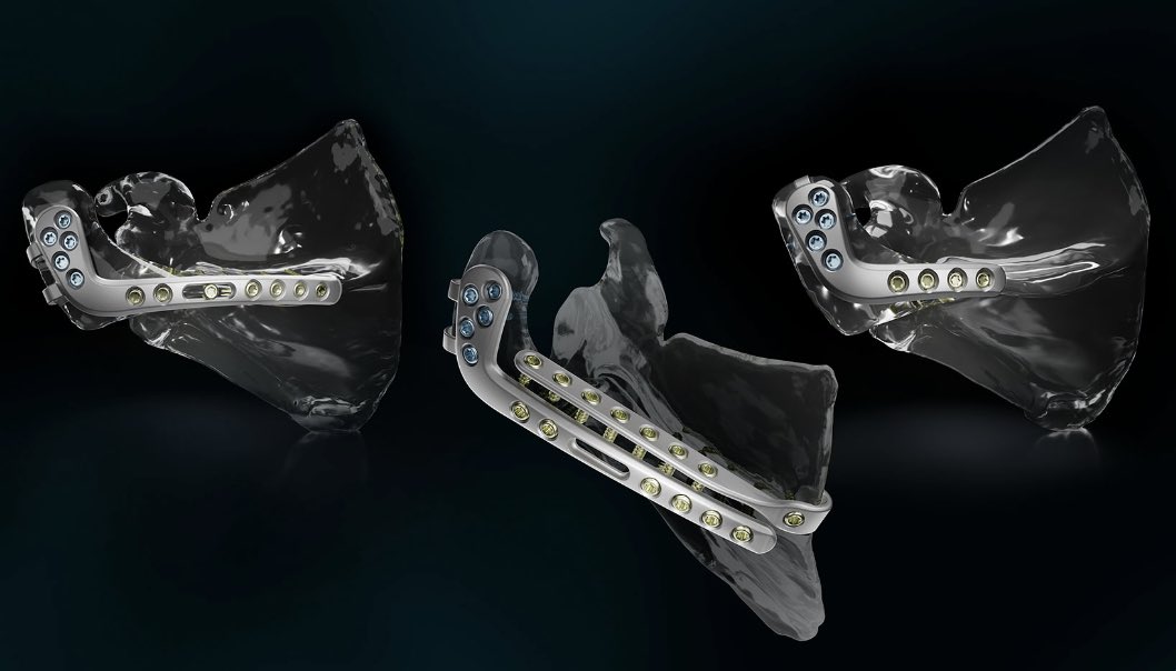 peter_a_cole's tweet photo. Cleveland Clinic's Great Shoulder Team
.....joined up for my last lab before launching Advita Equinoxe, the only acromial fracture solution for reverse Total Shoulder Arthroplasty. 1rst Case maiden voyage in Saint Paul tomorrow God willing!

https://t.co/uAPP0RYoMr

We had a blast discovering, sharing, learning.....
The morning lineup of cars descending at the main pavilion for patients entering for the 130 operating rooms is just like airport pickup at Christmas Time--what a Buzz!

#ClevelandClinic #ShoulderSurgery #OrthopaedicInnovation #ReverseShoulderArthroplasty #AdvitaOrthoEquinox