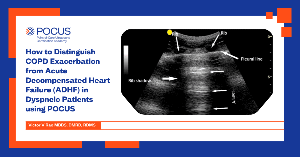 POCUSAcademy's tweet image. POCUS can quickly distinguish COPD exacerbation from ADHF at the bedside using a heart ➡️lung ➡️IVC approach. In our latest blog, Victor Rao explains how. Read more 👇
hubs.li/Q04d_ywj0

#POCUSEducation #POCUS