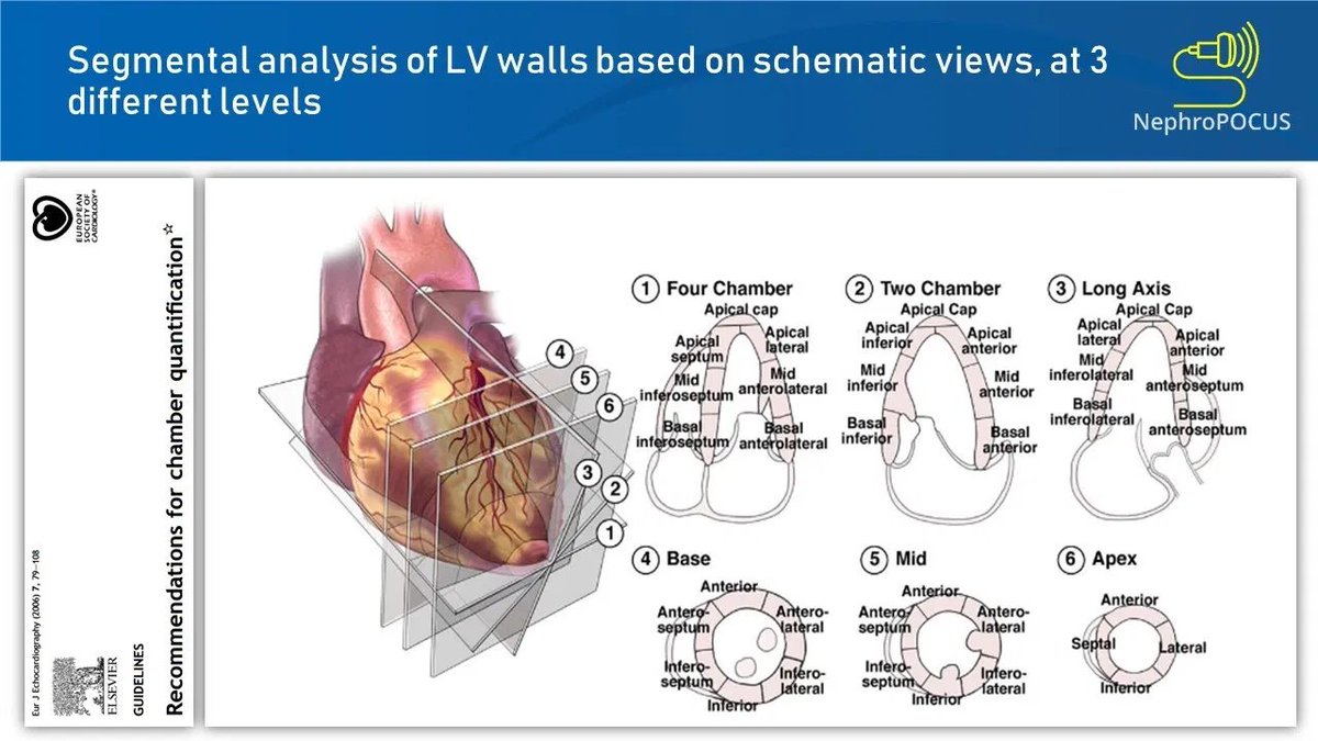 NephroP's tweet image. #POCUS quiz: (potential board question)
The myocardial segments most susceptible to false positive wall motion abnormalities are - 
1. ❓
2. ❓
#echofirst #FOAMed