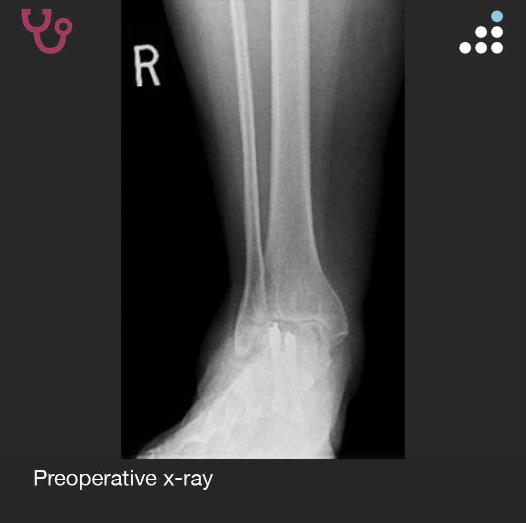 orthobullets's tweet image. Here is a new case by Dr. Jason Ahuero @AhueroMd and Houston Methodist Orthopedics &amp;amp; Sports Medicine @HMethodistMD.

ANKLE PAIN S/P SUBTALAR FUSION IN 59F

How would you manage this #orthotwitter?

Vote on this case for CME: orthobullets.tiny.us/ycktjabj