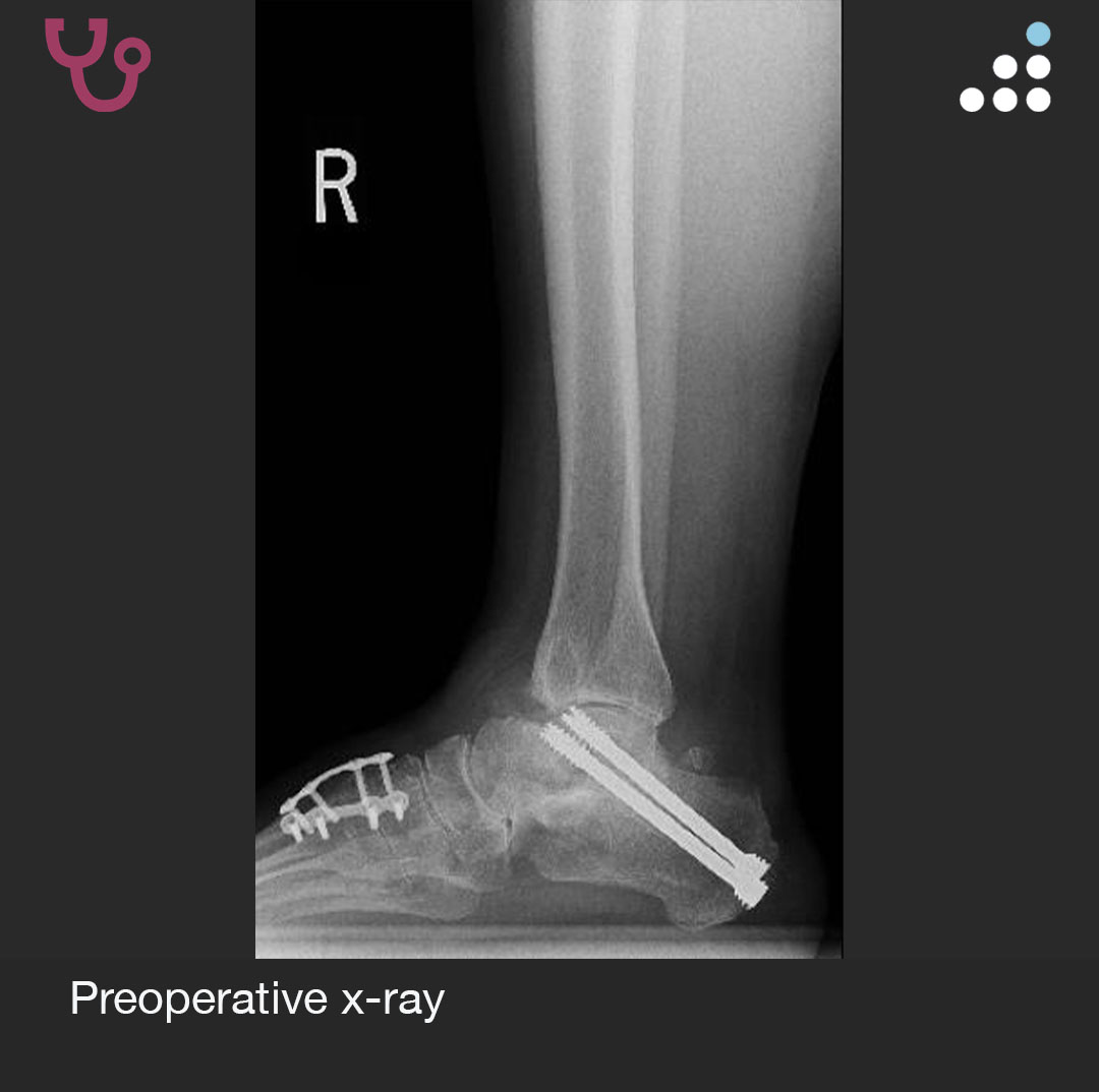 orthobullets's tweet image. Here is a new case by Dr. Jason Ahuero @AhueroMd and Houston Methodist Orthopedics &amp;amp; Sports Medicine @HMethodistMD.

ANKLE PAIN S/P SUBTALAR FUSION IN 59F

How would you manage this #orthotwitter?

Vote on this case for CME: orthobullets.tiny.us/ycktjabj