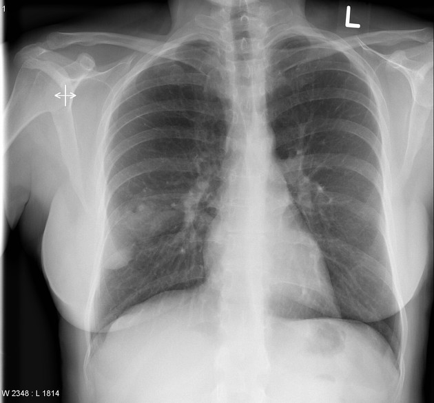 PeterItebimien's tweet image. A 32yr old ♂️ presents with recurrent nose bleeds since teenage years, increasing fatigue,dizziness and occasional shortness of breath. physical exam 👇,chest x-ray shows👇. What is the likely diagnosis ? Complications and treatment?
#MedTwitter #MedEd #Hematology #HemeTwitter