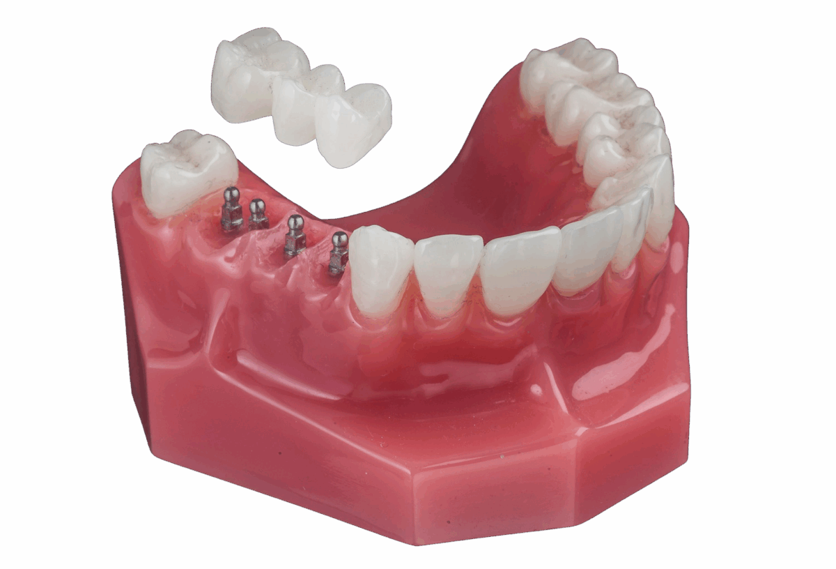 mdicasyracuse's tweet image. Is it painful to get a dental bridge? Book a free implant consultation with us to learn how we prioritize your comfort with mini implants! #syracuse #implant #dentist bit.ly/46brx9B