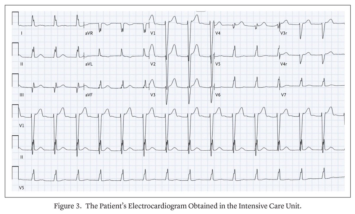 NEJMEvidence's tweet image. When shock does not improve after adequate fluid resuscitation, serial ECGs, cardiac biomarkers, and echocardiography can help identify cardiogenic or mixed shock. Learn more in a Morning Report by a team from @metrohealthCLE: eviden.cc/4lHONCz 

#Pediatrics #MedEd