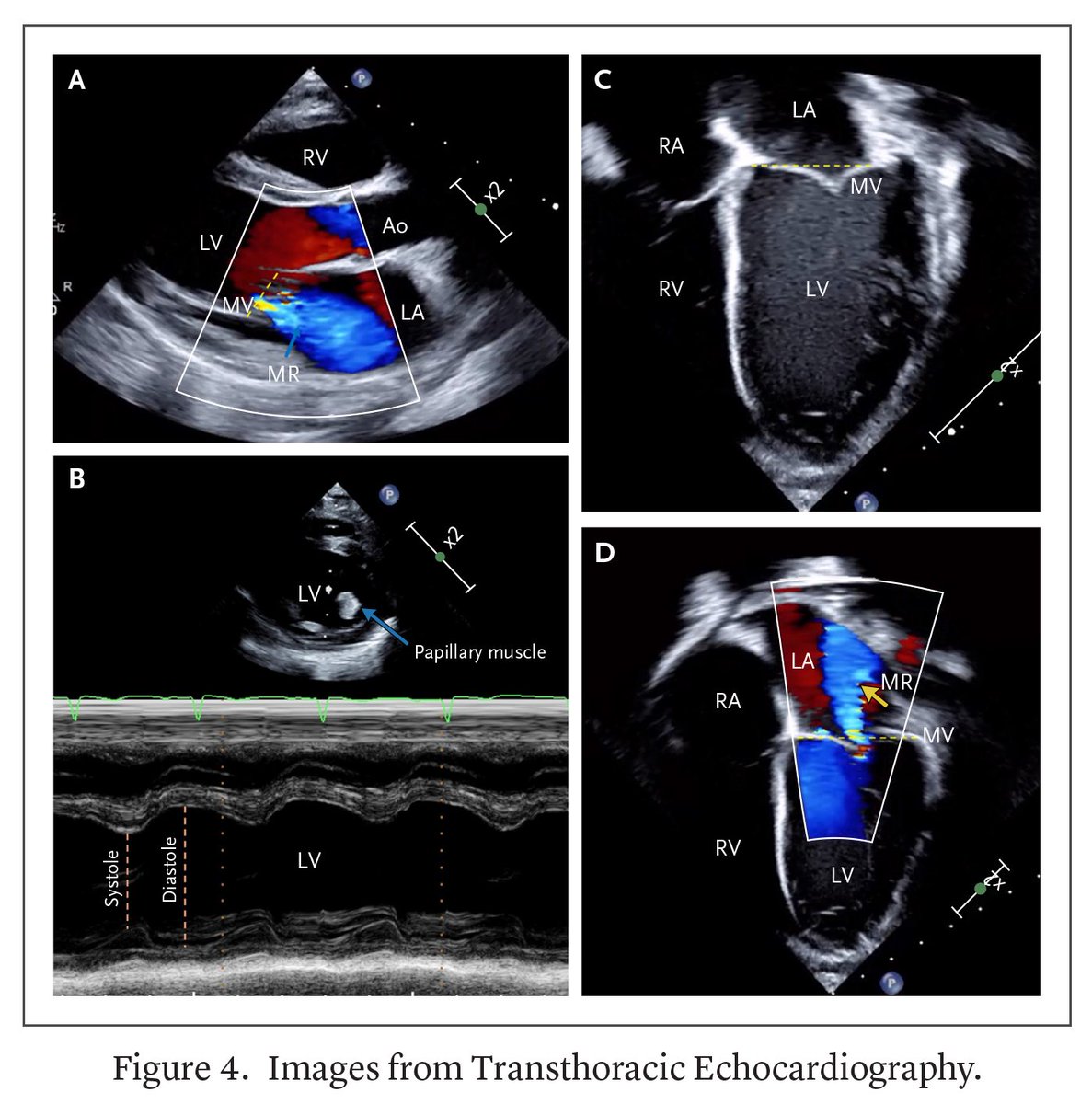 NEJMEvidence's tweet image. When shock does not improve after adequate fluid resuscitation, serial ECGs, cardiac biomarkers, and echocardiography can help identify cardiogenic or mixed shock. Learn more in a Morning Report by a team from @metrohealthCLE: eviden.cc/4lHONCz 

#Pediatrics #MedEd