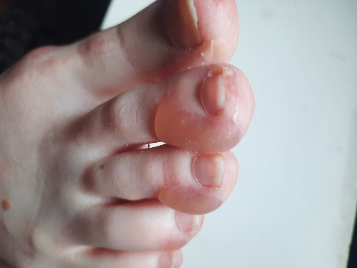 ALB33224914's tweet image. Horrible blisters from chemo. My poor girl.  #OvarianCancer #Stage4Cancer
#CancerSucks