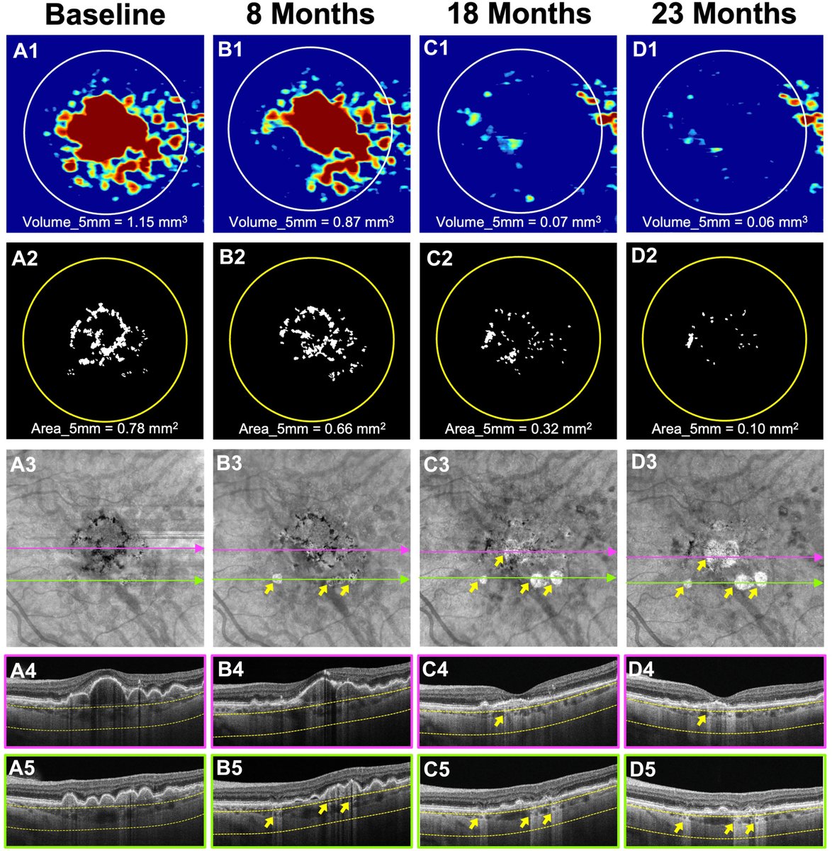 AAOjournal's tweet image. Novel Clinical Trial Designs for Intermediate AMD
ow.ly/L59P50YChMM
#ophthalmology