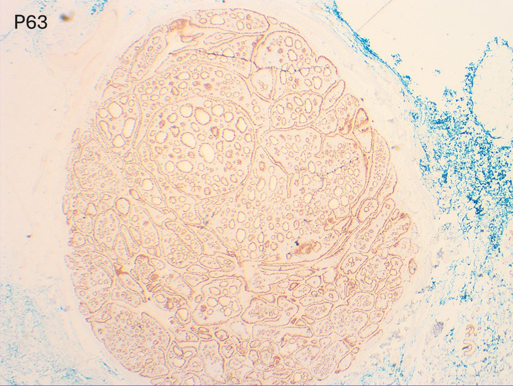 PathologyUSAH's tweet image. Spot on!! 👏
Primary cutaneous adenoid cystic carcinoma

Basal p63 and diffuse CD117 expression confirmed the diagnosis.

💥Pitfall: ~60% have MYB gene abnormalities but MYB IHC is non-specific as it can be seen in other adnexal tumors, such as cylindromas.

#Dermpath #PathX