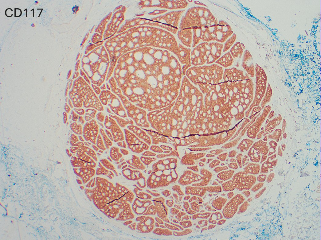 PathologyUSAH's tweet image. Spot on!! 👏
Primary cutaneous adenoid cystic carcinoma

Basal p63 and diffuse CD117 expression confirmed the diagnosis.

💥Pitfall: ~60% have MYB gene abnormalities but MYB IHC is non-specific as it can be seen in other adnexal tumors, such as cylindromas.

#Dermpath #PathX