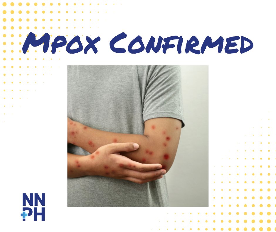 NNPH_Org's tweet photo. Two recent mpox cases in Washoe County were confirmed last week. These are the first reported locally since October 2022.

Read the full release for more info: https://t.co/ZnCrcwoOyy https://t.co/WuaawX8zza