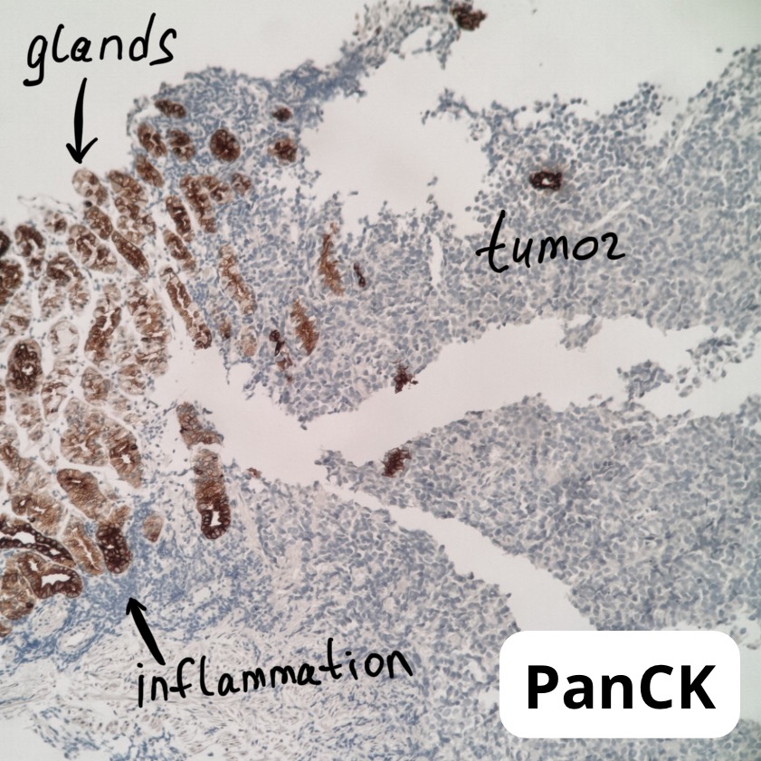 pathoblog's tweet photo. Gastric biopsy — almost called it poorly differentiated carcinoma. Lesson learned: always dig deeper on low-grade gastric tumors. 

Turned out to be metastatic melanoma. Patient had a history of melanoma. Never skip the clinical context. 🔬

#pathology #pathtwitter #gipath https://t.co/Y8XkXquer2