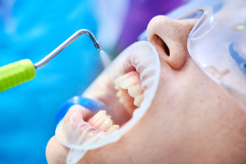 gzirakiandmd's tweet image. Watch this video to learn more about the utilization of micro air abrasion to assist in cleaning cavities in preparation for dental fillings. #eastlongmeadow #dentist bit.ly/4c4GaNq