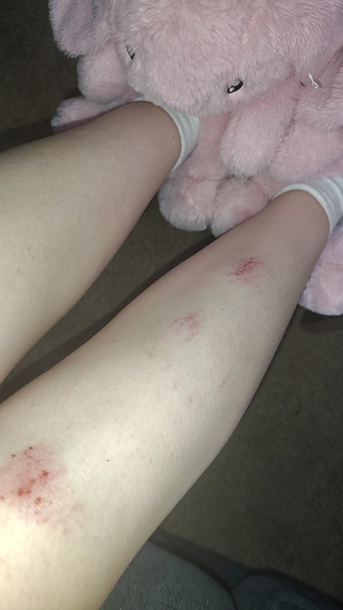 amelovespchan's tweet image. Yummy (⁎˃ᴗ˂⁎)!! I really like this picture omg #bunny #scratches #yuck #blood