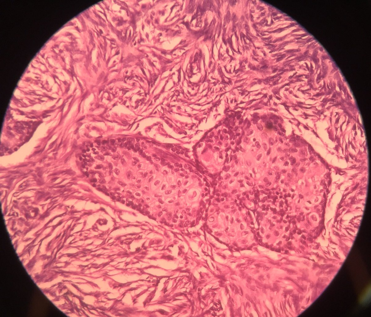 ManjulaNavamani's tweet image. Identify the organ and the lesion!!!
#learnpathologywithmanju 
#histopathdiagnosis
#pathx #pathtwitter
#pathresidents

 @MunchManju95
