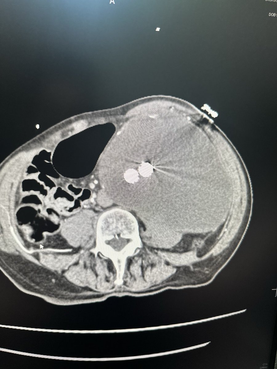JChurches's tweet photo. Measured ~7 cm in 2021 at the time of EVAR, now 15 cm. No contrast in the sac on CTA (no venous or delay performed). Doesn’t look like there’s a great seal proximally, but - no early contrast filling within the sac. #whatdoyoudo clips of axials and coronals when I get to a comp https://t.co/WYRT9WDYbq