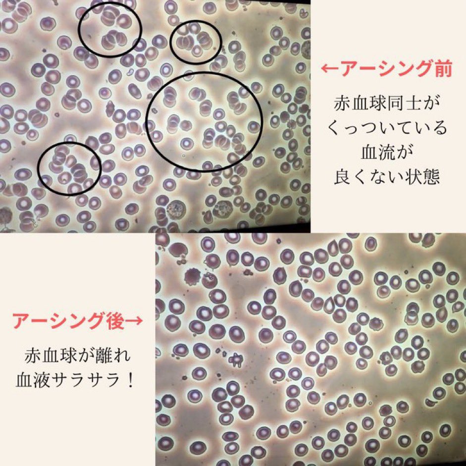 uroom_jp's tweet photo. 【10分で体がリセットされる神習慣】

実は裸足で自然に触れる『アーシング』は、最新研究で驚きの効果があることがわかっています。

○地面に直接触れると…
・体に溜まった静電気を放電
・炎症や痛みの軽減
・自律神経が整い、睡眠の質が改善
・足裏センサーが蘇り、姿勢が安定

必要なのはたった10分！
芝生や土、砂浜に裸足で立つだけで、体が勝手に調整を始めます。
※素手で触れるもOK！

『裸足で歩く』というシンプルで原始的な行為は、どんなクスリよりも効く最強のメンテナンスなんです！

便利さに囲まれた現代人ほど地面から切り離された生活をしていますが…。
その結果、疲労,不眠痛みなどの不調が慢性化しているのかもしれません。