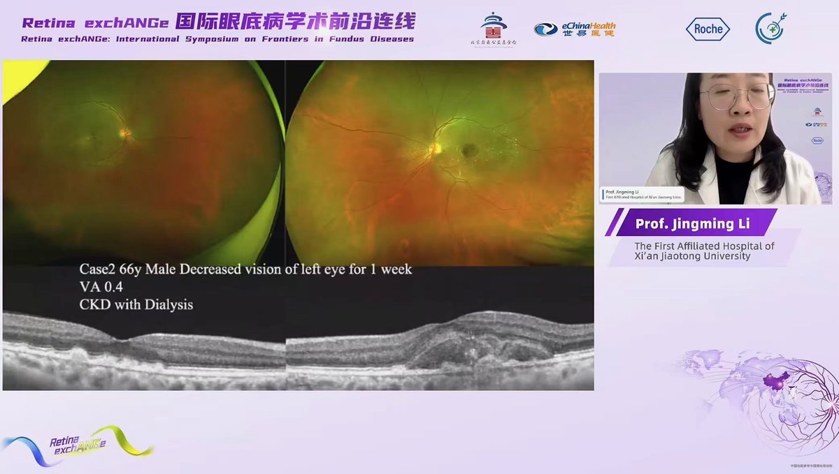 eChinaHealth's tweet image. The “Retina exchANGe – Global Frontiers in Retinal Disease” webinar brought together leading global experts, such as  Dr. Varun Chaudhary of @McMasterU, to explore the latest research advances and clinical trends in retinal diseases. 

 #Ophthalmology #retinal #retina #clinical