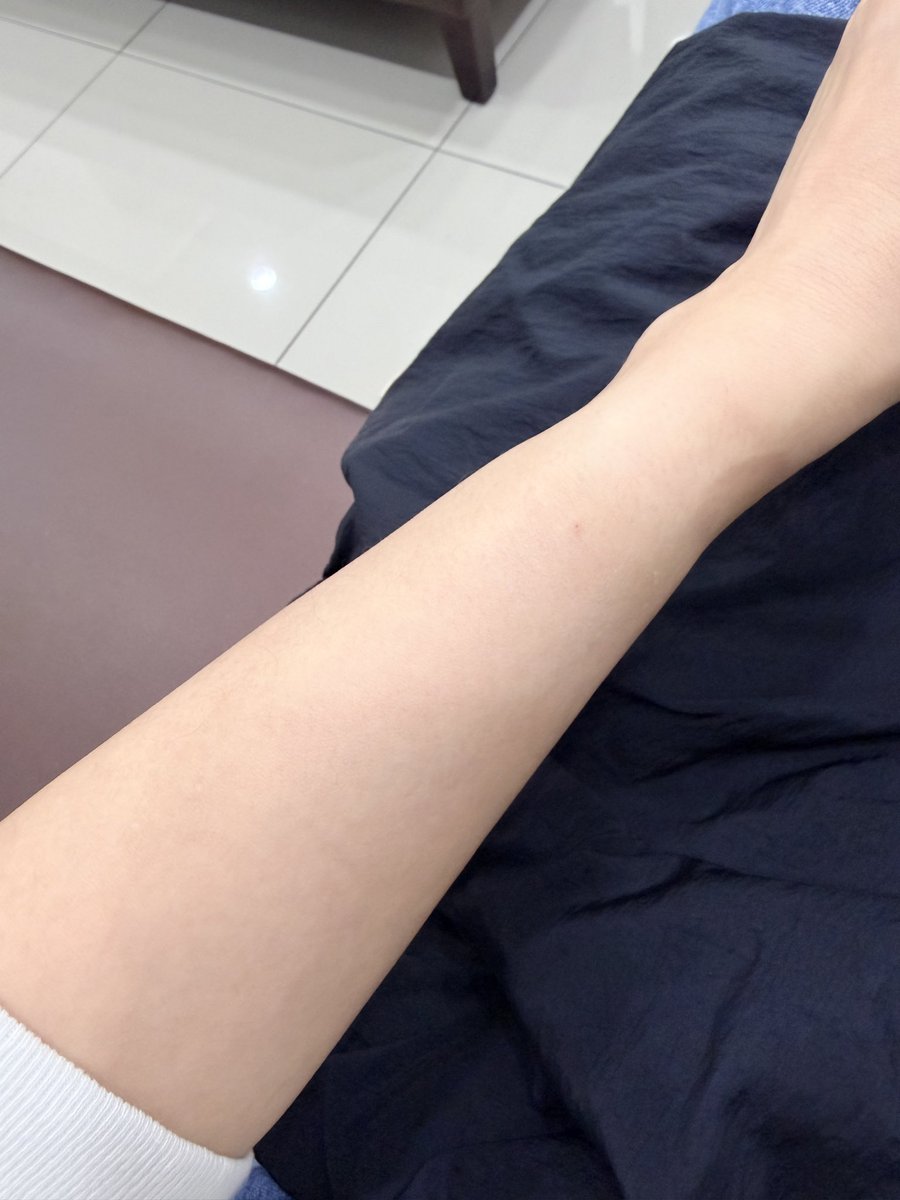 qqheeh's tweet photo. 오늘 위 내시경하는데 수액이 잘못들어가서 팔이 엄청나게 부어올랐고 동시에 너무 아팠다. 바늘을 뽑고 팔을 눌렀는데 아직도 부어있네. 피검사 후에도 혈관이 터져서~부었는데~ㅠㅠ https://t.co/W5isMn4CDM