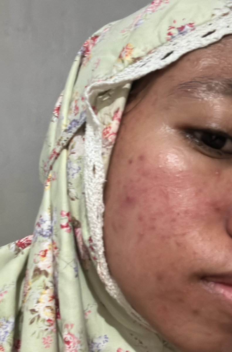 bibliothaps's tweet image. REDNESS, PIE, JERAWAT AKTIF ‼️‼️😱

jujur penemuan tergongg 2026, bener bener nangisin muka dan dari dulu udah coba cetaph*l, skin10*4, whit*lab, macem macem tp yang ini bisa benerin skin barier aku dalam waktu 2 MINGGU DOANG??? 

#acne #acnefighter #bekasjerawat #pie #labore