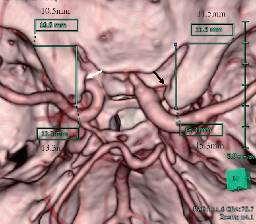 JNET(Journal of Neuroendovascular Therapy) tweet media