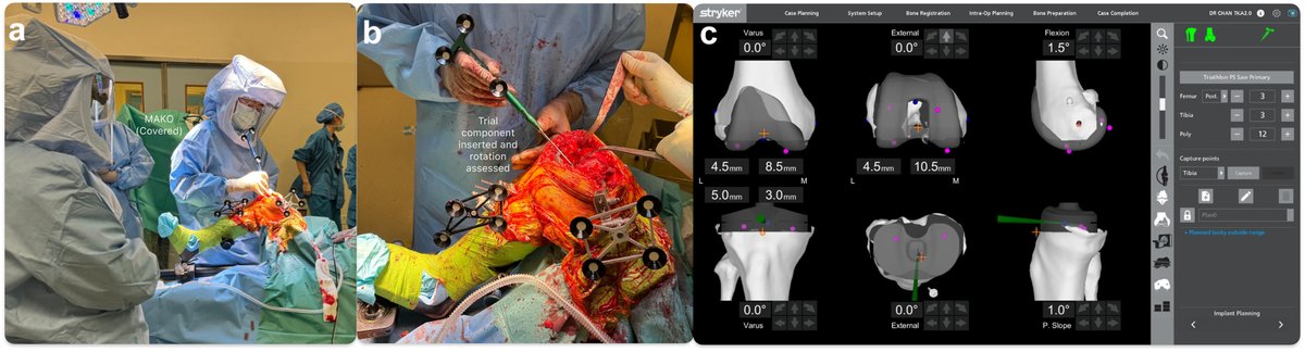 LCMLau's tweet photo. no patella, miserable malalignment, osteoarthritis - by using robotic TKA, we performed patella reconstruction and total knee replacement.  #SICOT Best Surgical Technique Award #Mako #JointReplacement #OrthopaedicSurgery #Orthopaedics #ORSSMC  https://t.co/q2VsGy71uw https://t.co/MAVv4Ib2DY