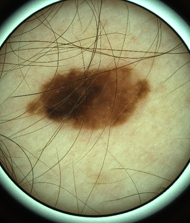 ScreenCancer_UK's tweet image. SkinCancerAwarenessMonth #MelanomaAwarenessMonth
Our whole month will be focused around this on our social media, a month long social media campaign📅
What is it? #SkinCancer is the abnormal, uncontrolled growth of skin cells, usually caused by DNA damage from UV radiation.