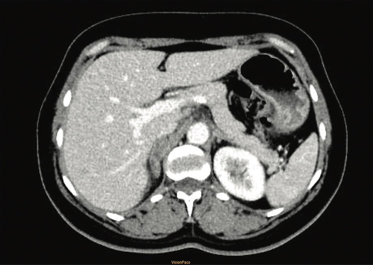 ESC_Journals's tweet image. When primary hyperaldosteronism masqueraded as peripartum cardiomyopathy ow.ly/RJxO50YShrR

#EHJCaseReports @Phiso_de @TJ_Yeo @aayshacader @BoldiKovacsMD @SukritiBanthiya @ANazmiCalik @O_Azizy_MD @saramoscatelli7 @EHJCREiC #CardioX