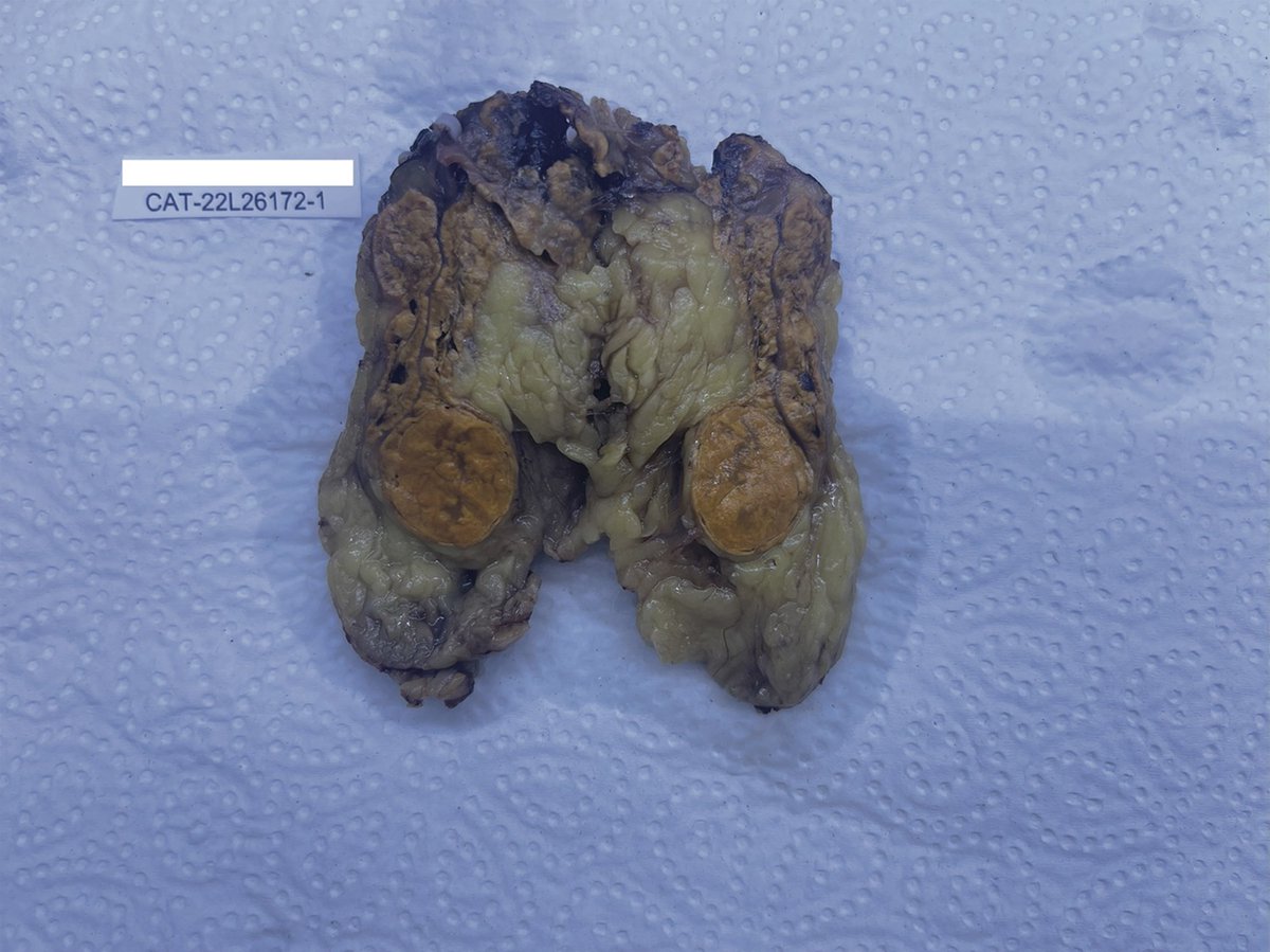 ESC_Journals's tweet image. When primary hyperaldosteronism masqueraded as peripartum cardiomyopathy ow.ly/RJxO50YShrR

#EHJCaseReports @Phiso_de @TJ_Yeo @aayshacader @BoldiKovacsMD @SukritiBanthiya @ANazmiCalik @O_Azizy_MD @saramoscatelli7 @EHJCREiC #CardioX