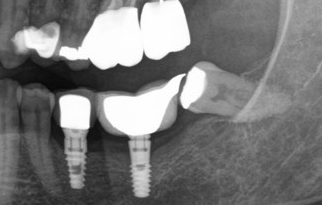RussellKirkDDS's tweet photo. Interesting restorative option. Quite creative. https://t.co/3hBnLBpu3R