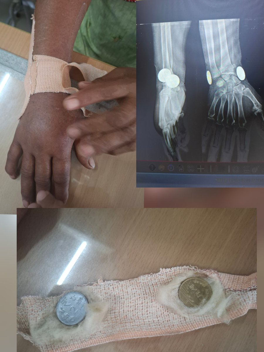 UMY_35's tweet image. Immoblization for fracture done using Coins by quack - Somewhere in Haryana 
Total Cost- 100+ Coin cost (2+5) = 107
#medtwitter #orthotwitter @Ortho @HopkinsOrtho @AOFoundation @