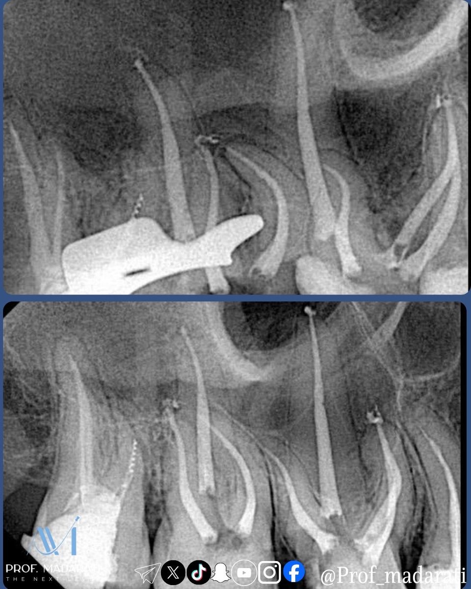 ProfMadarati's tweet photo. English / عربي Post:
#16166:
Missing the MB2 has been reported as one of the most important factors for failure of primary RCTs of upper molars. 
عدم معالجة القناة الانسية الدهليزية الثانية يعد من اهم اسباب فشل المعالجات اللبية في الارحاء العلوية 

One study (link below) found that the incidence of a MB2 canal in first molar retreatments was 67% compared to a 59% incidence in initial treatments. Whereas in second molars, the retreatment incidence was 44% compared with 35% in initial treatments. 
احدى الدراسات (الرابط بالاسفل) وجدت ان نسبة القناة الانسية الدهليزية الثانية اثناء اعادة المعالجة اللبية هي ٦٧ و ٥٩٪ ( بالاراء الاولى و الثانية تباعا) و هي اعلى من نسبة تواجدها بالمعالجات الاساسية (٤٤ و ٣٥٪ ). 

The root canals in the presented case were prepared using the BlueShaper Pro rotary files from Zarc4Endo  
تم تحضير الاقنية الجذرية بمبارد بلو شير برو من شركة زارك 

Obturation with the modified hot tech. 
حشي الاقنية الجذرية تم باستخدام طريقة التكيف الحراري المعدلة

https://t.co/ytIsPzyVWQ

#prof_madarati_endodontics #excellence_in_endodontics #next_level_endodontics #why #how