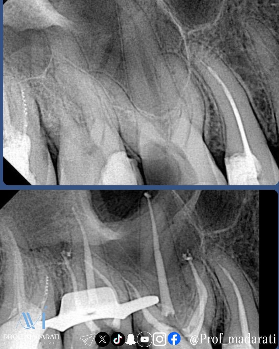 ProfMadarati's tweet photo. English / عربي Post:
#16166:
Missing the MB2 has been reported as one of the most important factors for failure of primary RCTs of upper molars. 
عدم معالجة القناة الانسية الدهليزية الثانية يعد من اهم اسباب فشل المعالجات اللبية في الارحاء العلوية 

One study (link below) found that the incidence of a MB2 canal in first molar retreatments was 67% compared to a 59% incidence in initial treatments. Whereas in second molars, the retreatment incidence was 44% compared with 35% in initial treatments. 
احدى الدراسات (الرابط بالاسفل) وجدت ان نسبة القناة الانسية الدهليزية الثانية اثناء اعادة المعالجة اللبية هي ٦٧ و ٥٩٪ ( بالاراء الاولى و الثانية تباعا) و هي اعلى من نسبة تواجدها بالمعالجات الاساسية (٤٤ و ٣٥٪ ). 

The root canals in the presented case were prepared using the BlueShaper Pro rotary files from Zarc4Endo  
تم تحضير الاقنية الجذرية بمبارد بلو شير برو من شركة زارك 

Obturation with the modified hot tech. 
حشي الاقنية الجذرية تم باستخدام طريقة التكيف الحراري المعدلة

https://t.co/ytIsPzyVWQ

#prof_madarati_endodontics #excellence_in_endodontics #next_level_endodontics #why #how