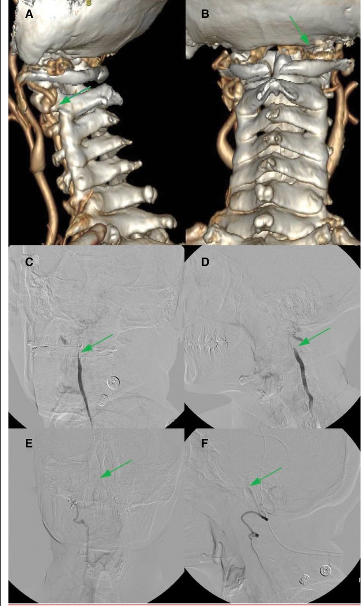 StrokeAHA_ASA's tweet image. #Stroke Image highlights the phenomenon of Bow Hunter's Syndrome. ahajrnls.org/4tj6nzi