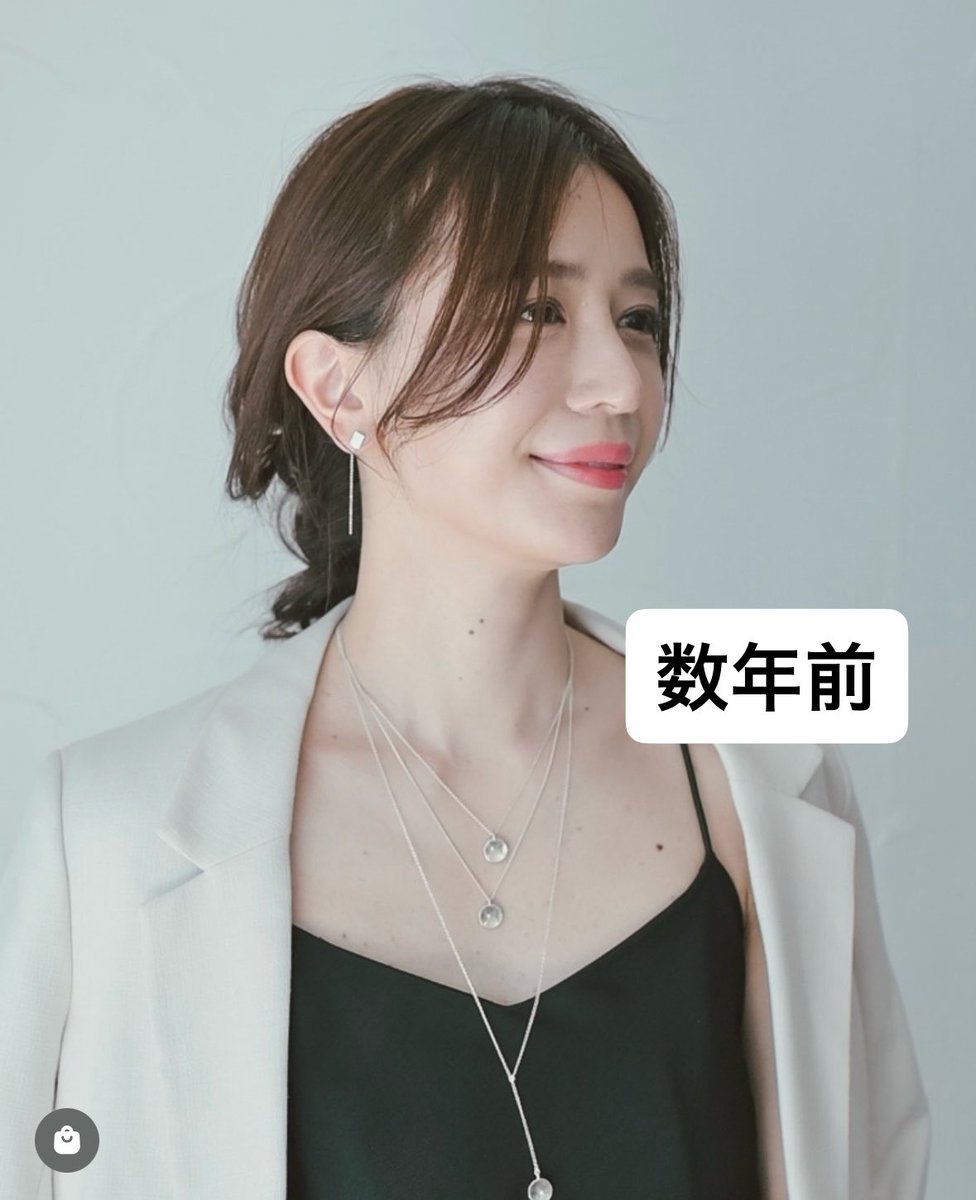 maruyumi's tweet photo. 数年前、あれほど絶望してた「たるみとほうれい線」が今ほぼ消滅してることに気づいた😭さほど美容医療をしていないので、RFのお陰だと断言出来る。具体的には、ひたすらセリニュー。 RFって派手な変化が出ないし、まぁお値段張るから不安になるけど、信じて続けてた自分を全力で褒めちぎる夜にします https://t.co/lIt3vSScv2